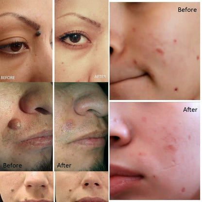 SkinPerfect Plasma Pen Mole & Spot Eraser